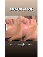 エルチェーロ(El Chulo)/LUMIX-A9Xヒゲ脱毛