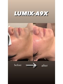 エルチェーロ(El Chulo)/LUMIX-A9Xヒゲ脱毛