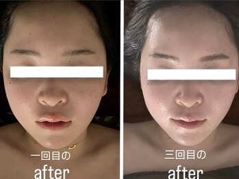 優癒/三回目の頭脳美クレンズ小顔調整