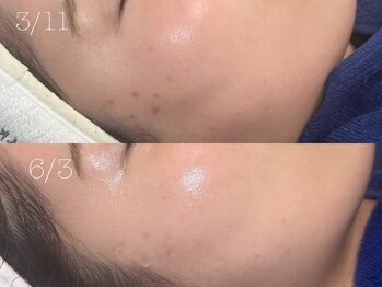 ロイ 初生店(LOI)/プラズマ×リジュラン