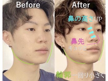 ラプリエイル 千葉店(Raplit aile)/ 隆鼻+輪郭矯正40分 #小顔矯正