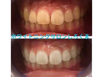 シロクマ(siroQMa)/自然に見えて、好印象な口元へ