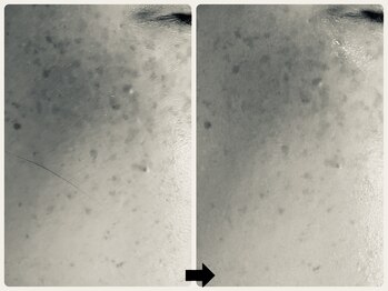 エフェクト 塚口店(effect)/Before After