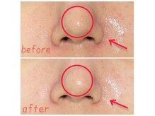 毛穴・くすみ、無かったことに◎剥離なし日本製ハーブピーリング