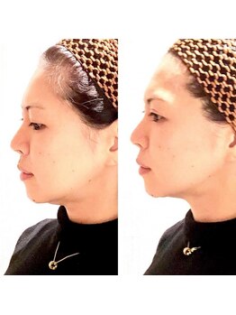 エミリー 守山(EMILY)の写真/≪最強セット！即効果◎「小顔矯正」がスゴい≫★当店イチオシ★【EMS＋小顔矯正が¥5000】