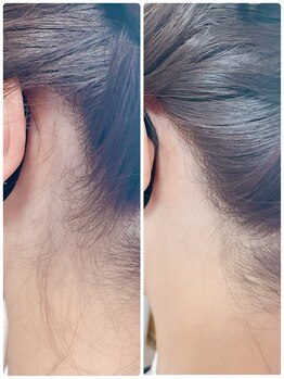 ニコリ(Nicori)/うなじシェービング&脱毛