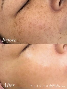 シェーン(Schon)/IPL美肌光フォト