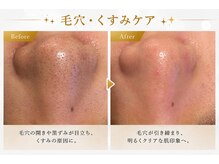 マインドエステ 仙台店(mindエステ)の雰囲気（人気の毛穴洗浄で汚れをゴッソリお掃除♪）