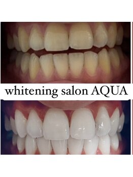 アクア 天王寺店(AQUA)/セルフホワイトニング効果