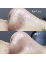 サロン ド ソワン(salon de soin)/毛穴エクストラクション