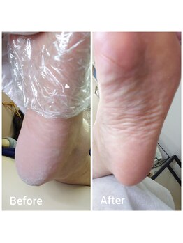 リゼラアンドコー 御茶ノ水店/《角質ケア》