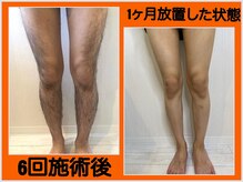 ファシネイト 新宿本店(Fascinate)/脚脱毛！全身脱毛でまとめても◎