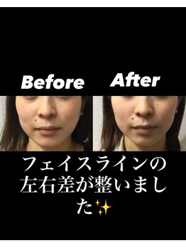 整体院オアシス イオンモール福津店(OASIS)/小顔施術【ビフォーアフタ―】