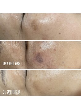 武蔵小杉リンパサロン かおりの部屋/シミに効果的な光フェイシャル