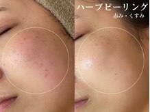 クレスト(CLEST.)/ハーブピーリング（全顔）