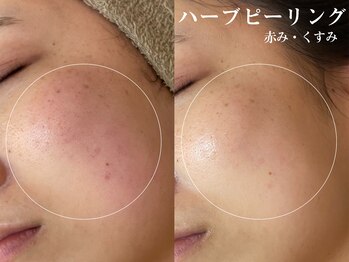 クレスト(CLEST.)/ハーブピーリング（全顔）