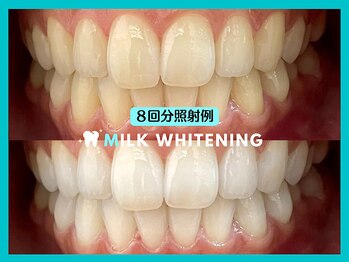 ミルクホワイトニング 新大村店(Milkホワイトニング)/★施術例