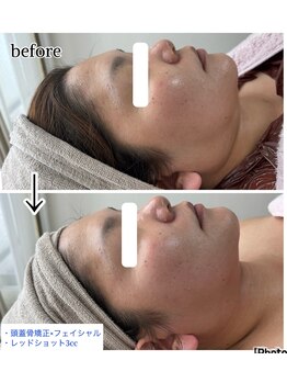 ノリスズ(NORI SUZU)/レッドショット×頭.顔の矯正