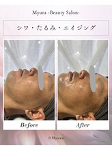 myura/メソプロ、毛穴、エイジング