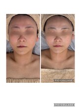 リンダ(Rinda)/小顔リフトマシンで左右差改善★