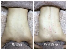 シェミー(CHEZ MEE)/【美ボディ】背中ニキビケア