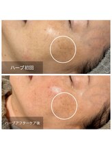 ラペ(la paix)/フェイシャル症例写真/50代