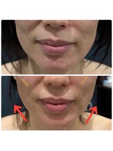 キュライム 熊本(CURAIM)/造顔πセラピー【40代女性】