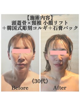 マルウル(maluulu)の写真/【頭蓋骨×頸椎 小顔リフト】で理想の小顔へ！戻りにくい小顔を実感♪
