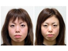 フィシス/小顔&エラ張り改善