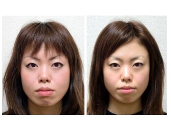 フィシス/小顔&エラ張り改善