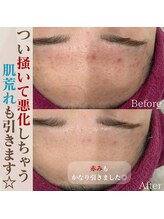 タグ 高知駅前店(Tug)/ハーブピーリング