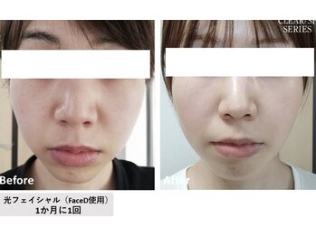 キュー(cue)/光フェイシャル