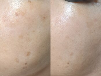 エレヌイ(ELENUI)/最新光フェイシャル★シミ改善