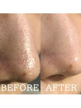 アマリリス(Amaryllis)/毛穴洗浄before/after