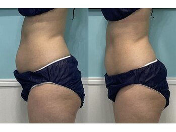 ビーナスアイスブルー(Venus ICE BLUE)/凄すぎちゃった