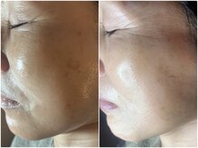 スパークル/シミケア/フェイシャル/美白