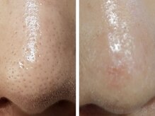 GRACETHOUSAND(グレイスサウザンド)/【韓国肌管理】ララピール