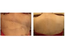 ビューティースパ/背中美人→背中ニキビケアで改善