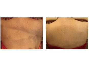 ビューティースパ/背中美人→背中ニキビケアで改善