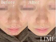 ライム 新越谷(LIME)/ハーブピーリング｜ニキビケア