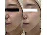 【人気NO2!!美肌×小顔】高濃度エクソソーム導入×超小顔EMSパルス