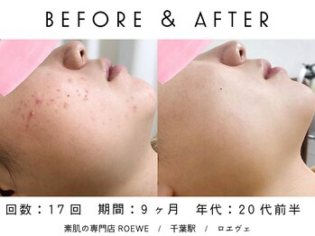 ロエヴェ(ROEWE)/ニキビ改善・毛穴ケア・肌質改善