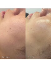 スターチス(Statice)/水分量UP