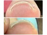 NEW☆【FOOT】ワンカラー＋巻き爪矯正ネイル(親指2本)15400円→13200円