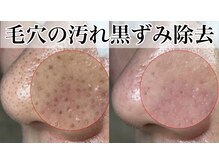 毛穴の黒ずみを徹底的にかき出す専門ケア！毛穴除去5980円