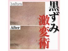 ホワイトアクア 天王寺本店(WHITE AQUA)/ハーブピーリング/大阪/天王寺