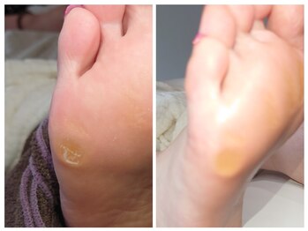 アンティ(Aunty)/小指下のタコ(胼胝)