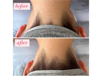 エム(M)/うなじビフォーアフター