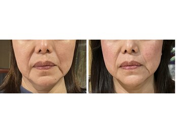 ねこのひげ/お顔の変化