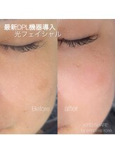 キレイシェア バイ プリンセスローズ静岡駅店(KIREI SHARE)/光フェイシャル